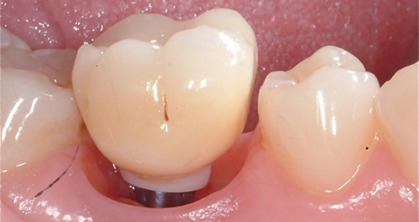 Implante + corona en Clínica Dental Vallecas